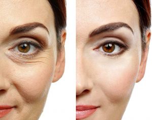 CarboxyTherapy for dark circles